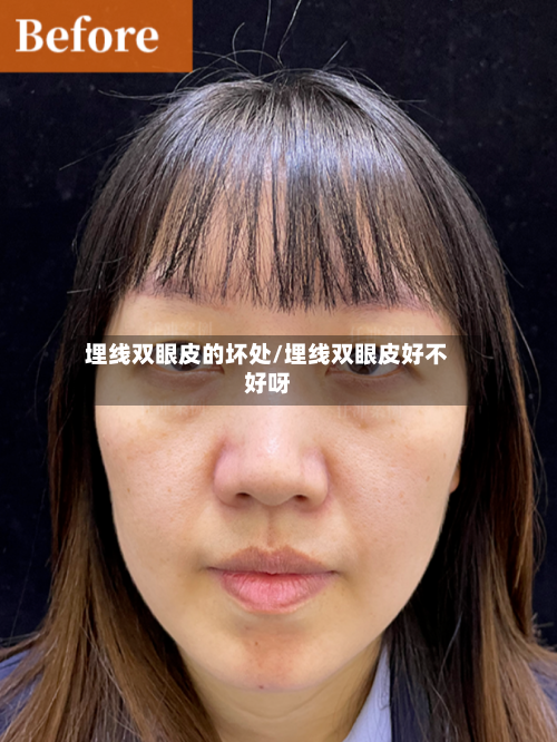 埋线双眼皮的坏处/埋线双眼皮好不好呀