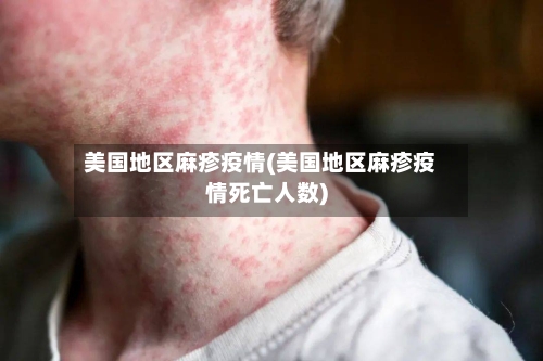 美国地区麻疹疫情(美国地区麻疹疫情死亡人数)